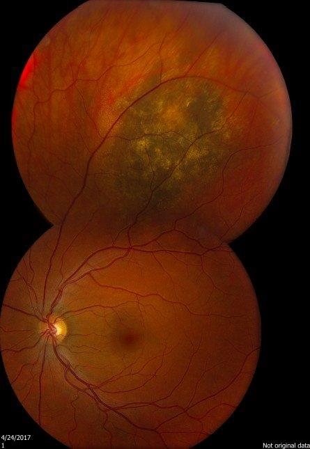 Choroidal Nevus With Lipofuscin