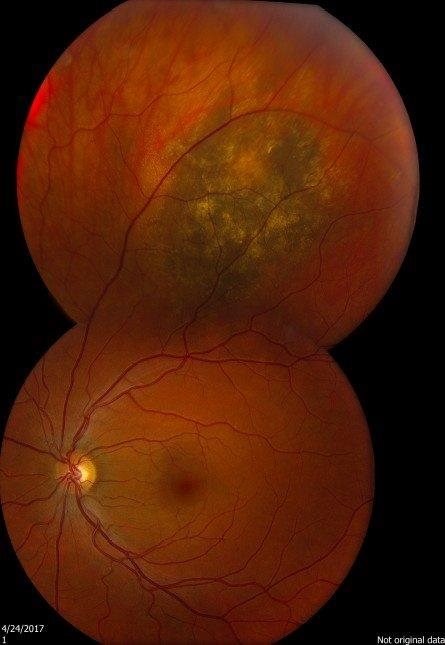 /COO/media/Media/CMGs/Pigmented-Fundus-Lesions-2-Large-445x645.jpg