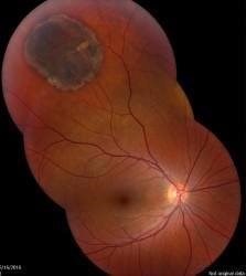 /COO/media/Media/CMGs/Pigmented-Fundus-Lesions-4-Small-223x250.jpg